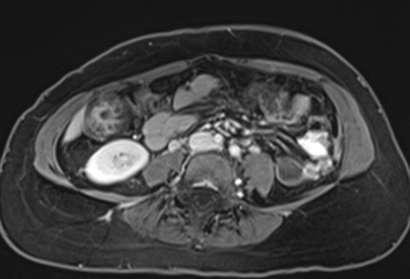 File:Chronic pancreatitis - pancreatic duct calculi (Radiopaedia 71818-82250 Axial T1 C+ fat sat 52).jpg