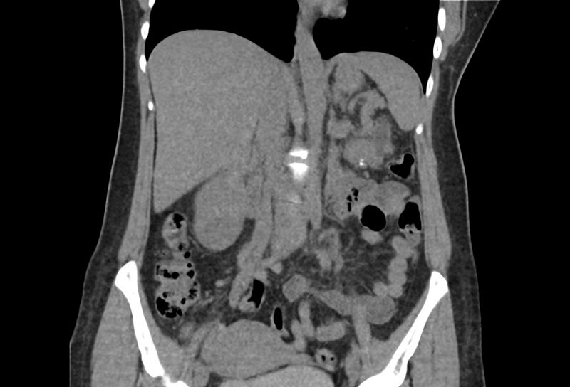 File:Chronic pancreatitis - pancreatic duct calculi (Radiopaedia 71818-82251 Coronal non-contrast 23).jpg