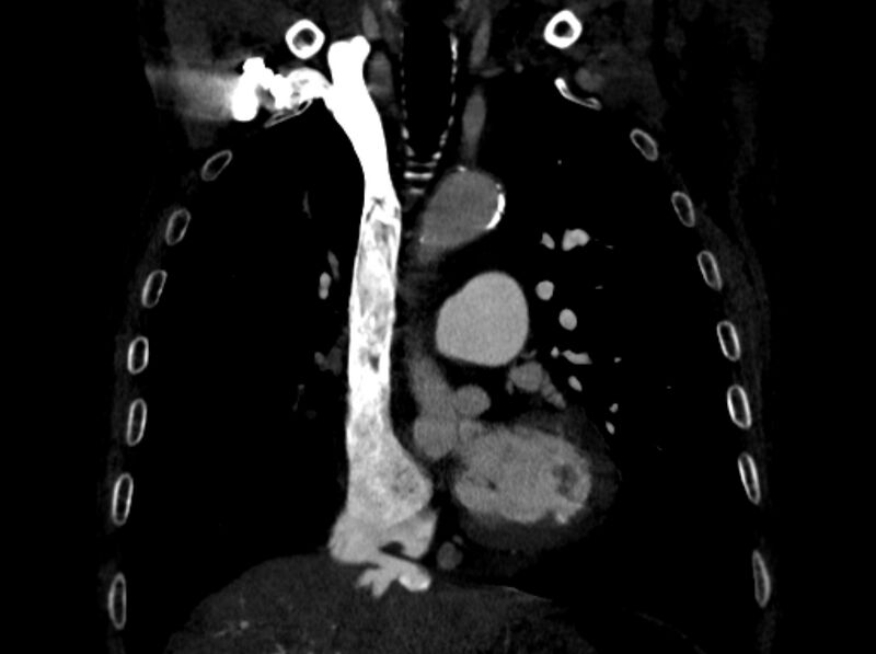 File:Chronic pulmonary embolism (Radiopaedia 91241-108843 A 43).jpg