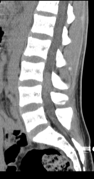File:Clear cell meningoma - lumbar spine (Radiopaedia 60116-67691 A 23).png
