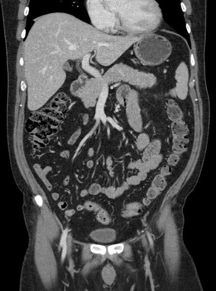 File:Clear cell renal cell carcinoma (Radiopaedia 61449-69393 F 2).jpg