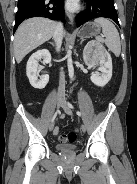 File:Clear cell renal cell carcinoma (Radiopaedia 61449-69393 F 23).jpg