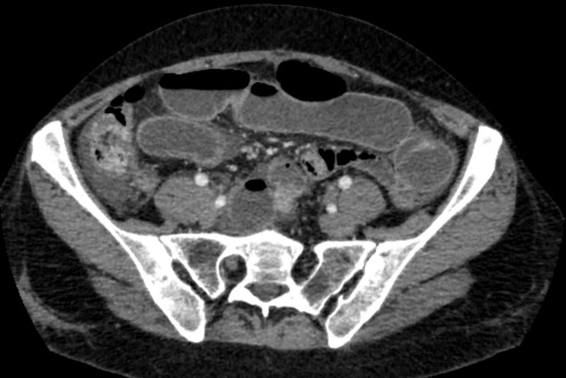 File:Closed loop small bowel obstruction (Radiopaedia 71211-81508 A 107).jpg