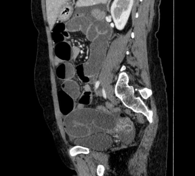 File:Closed loop small bowel obstruction (Radiopaedia 71211-81508 C 101).jpg