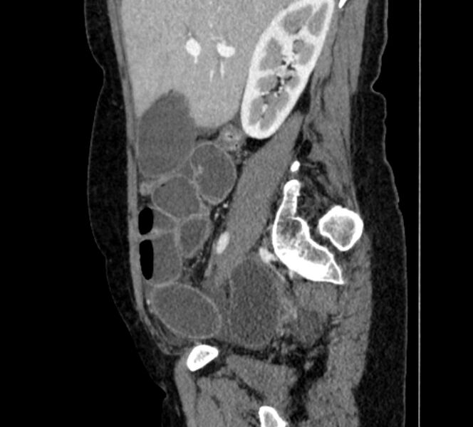 File:Closed loop small bowel obstruction (Radiopaedia 71211-81508 C 37).jpg