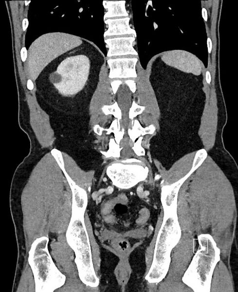 File:Closed loop small bowel obstruction - internal hernia (Radiopaedia 57806-64778 A 85).jpg
