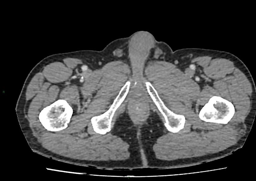 Closed loop small bowel obstruction with ischemia (Radiopaedia 84180-99456 A 130).jpg