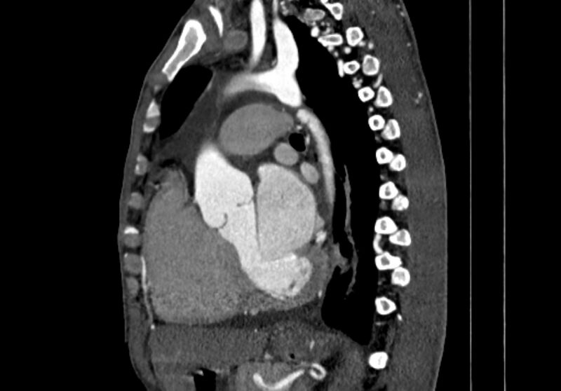 File:Coarctation of aorta with aortic valve stenosis (Radiopaedia 70463-80574 B 85).jpg