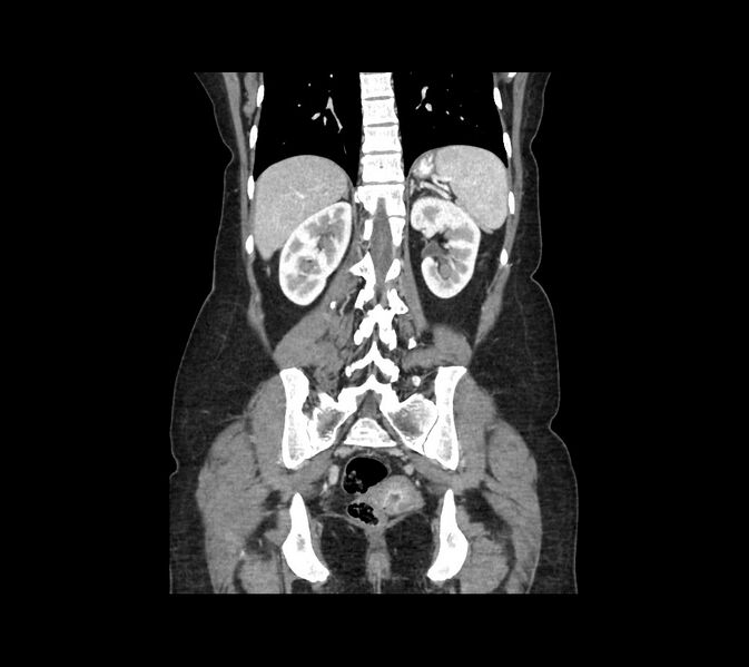 File:Cocoon abdomen with possible tubo-ovarian abscess (Radiopaedia 46235-50636 B 39).jpg