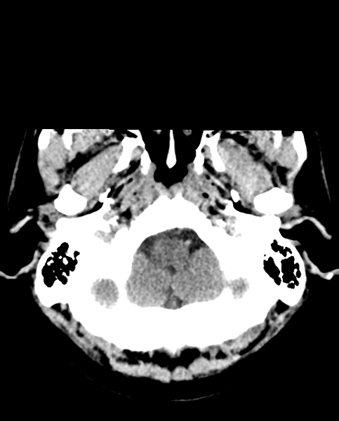 File:Colloid cyst of the third ventricle (Radiopaedia 86571-102661 Axial non-contrast 7).png