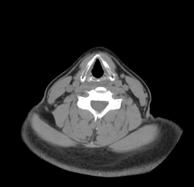 File:Colloid cyst of thyroid (Radiopaedia 22897-22923 Axial non-contrast 32).jpg