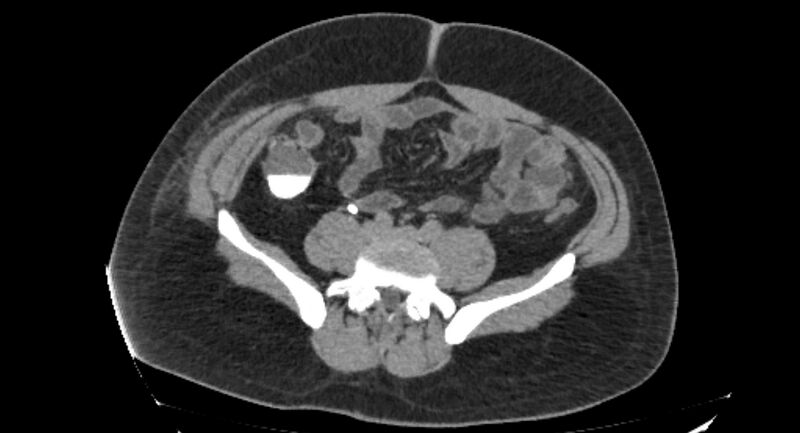 File:Colocutaneous fistula (Radiopaedia 56401-63062 Axial Fistulography 25).jpg