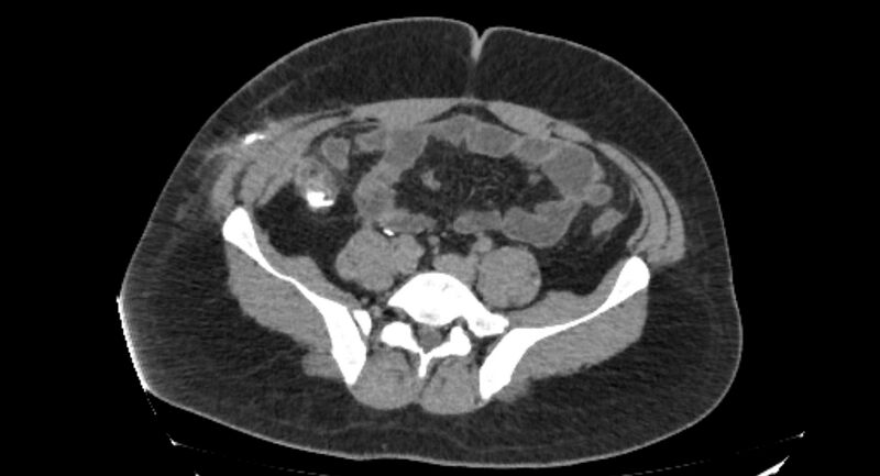 File:Colocutaneous fistula (Radiopaedia 56401-63062 Axial Fistulography 29).jpg