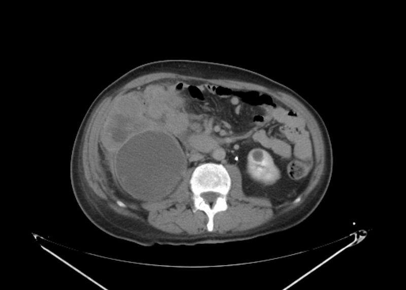 File:Colon cancer mimicking renal cell carcinoma (Radiopaedia 28986-29335 Axial C+ delayed 37).jpg