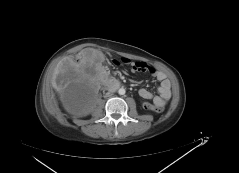 File:Colon cancer mimicking renal cell carcinoma (Radiopaedia 28986-29335 C 40).jpg