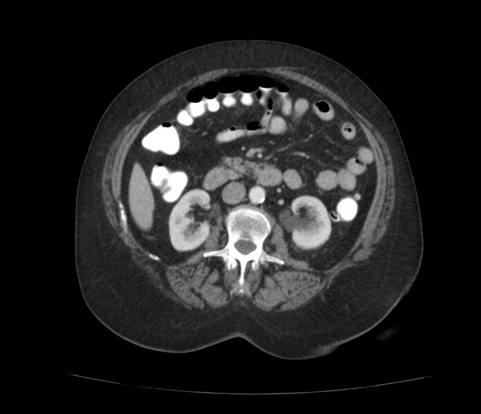 File:Colonic diverticulosis (Radiopaedia 22934-22957 A 32).jpg
