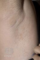 Fox-Fordyce disease (DermNet NZ hair-nails-sweat-fox-fordyce4).jpg