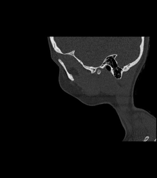 File:Nasoorbitoethmoid fracture (Radiopaedia 90044-107205 Sagittal bone window 26).jpg