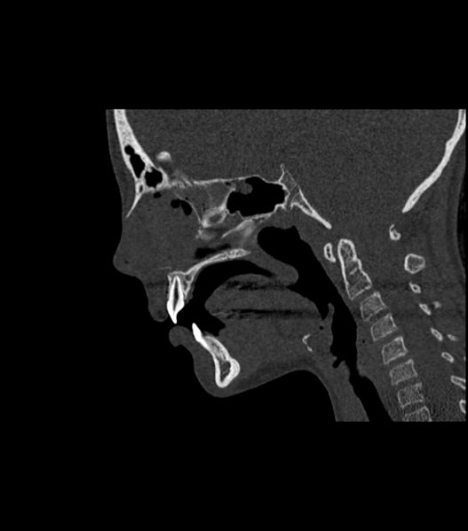 File:Nasoorbitoethmoid fracture (Radiopaedia 90044-107205 Sagittal bone window 74).jpg