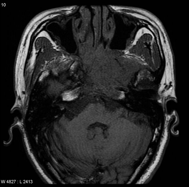 File:Nasopharyngeal carcinoma (Radiopaedia 4546-6667 Axial T1 4).jpg