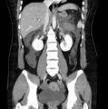 Necrotizing pancreatitis (Radiopaedia 23001-23031 B 40).jpg