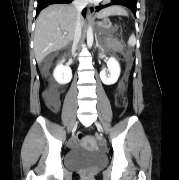 File:Necrotizing pancreatitis (Radiopaedia 23001-23031 B 40).jpg