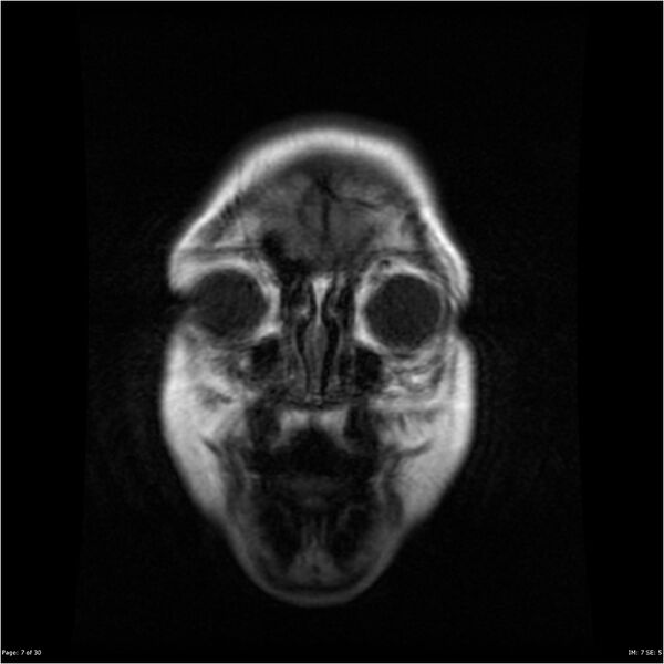 File:Neurofibromatosis type 1 (Radiopaedia 22541-22564 Coronal T1 7).jpg