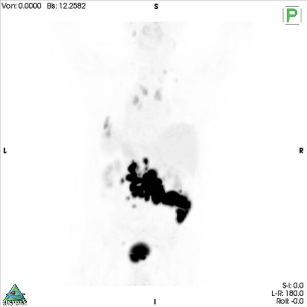 File:Non-Hodgkin lymphoma involving seminal vesicles with development of interstitial pneumonitis during Rituximab therapy (Radiopaedia 32703-33675 PET cor 3D MIP 7).jpg