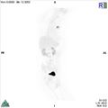 Non-Hodgkin lymphoma involving seminal vesicles with development of interstitial pneumonitis during Rituximab therapy (Radiopaedia 32703-33752 PET cor 3D MIP 11).jpg