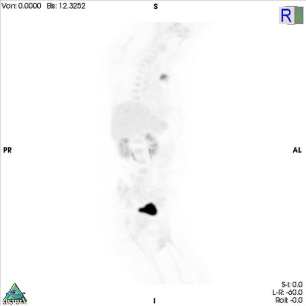File:Non-Hodgkin lymphoma involving seminal vesicles with development of interstitial pneumonitis during Rituximab therapy (Radiopaedia 32703-33752 PET cor 3D MIP 11).jpg