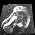 Non-compaction of the left ventricle (Radiopaedia 38868-41062 E 1).jpg