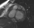 Non-compaction of the left ventricle (Radiopaedia 69436-79314 Short axis cine 169).jpg