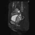 Non-puerperal uterine inversion (Radiopaedia 78343-90983 Sagittal T2 fat sat 20).jpg