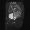 Non-puerperal uterine inversion (Radiopaedia 78343-90983 Sagittal T2 fat sat 9).jpg