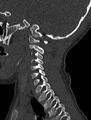 Normal CT cervical spine - pediatric (Radiopaedia 52549-58462 Sagittal bone window 52).jpg