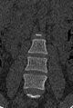 Normal CT lumbar spine (Radiopaedia 53981-60118 Coronal bone window 13).jpg