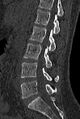 Normal CT lumbar spine (Radiopaedia 53981-60118 Sagittal bone window 43).jpg