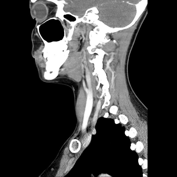 File:Normal CT of the neck (Radiopaedia 14575-14500 Sagittal C+ 19).jpg