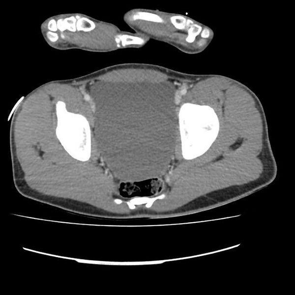 File:Normal dual-phase trauma CT chest,abdomen and pelvis (Radiopaedia 48092-52899 A 105).jpg