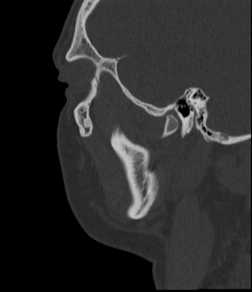 Normal facial bone CT (Radiopaedia 88742-105476 Sagittal bone window 42).jpg