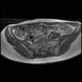 Normal female pelvis MRI (retroverted uterus) (Radiopaedia 61832-69933 Axial T1 8).jpg