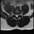 Normal lumbar spine MRI (Radiopaedia 35543-37039 Axial T2 13).png