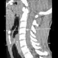 Normal trauma cervical spine (Radiopaedia 41017-43760 Coronal non-contrast 1).png