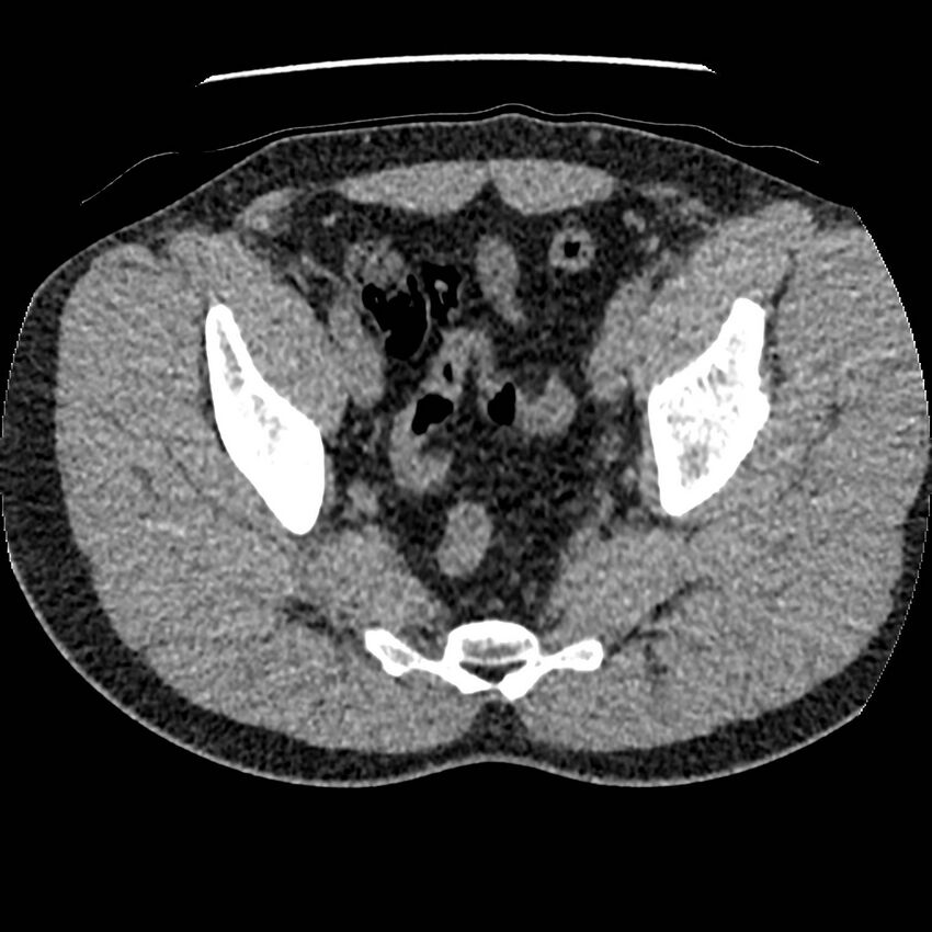 Obstructing ureteric calculus and ureteric anatomy (Radiopaedia 62730-71042 Axial non-contrast 142).jpg