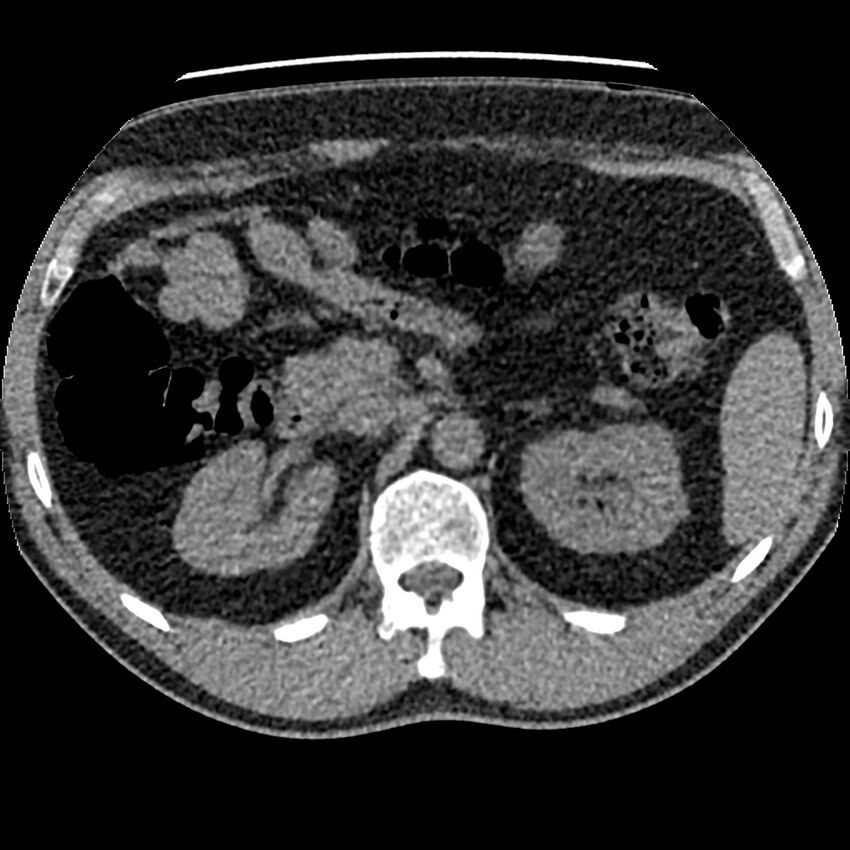 Obstructing ureteric calculus and ureteric anatomy (Radiopaedia 62730-71042 Axial non-contrast 26).jpg