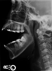 Bilateral anterior dislocation of the jaw