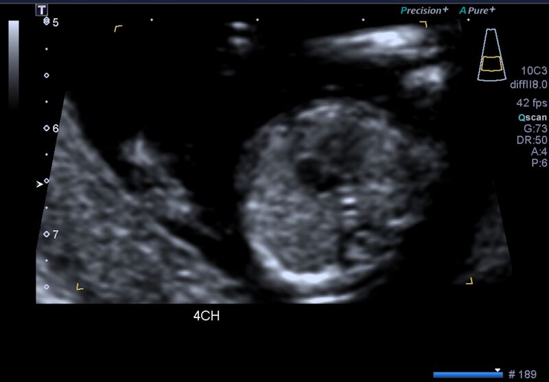 File:1st trimester nuchal-morphology ultrasound (Radiopaedia 44706-48477 General anatomy and NT 19).jpg