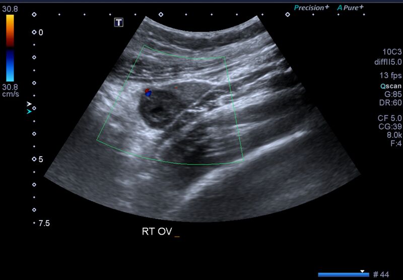File:1st trimester nuchal-morphology ultrasound (Radiopaedia 44706-48477 General anatomy and NT 50).jpg