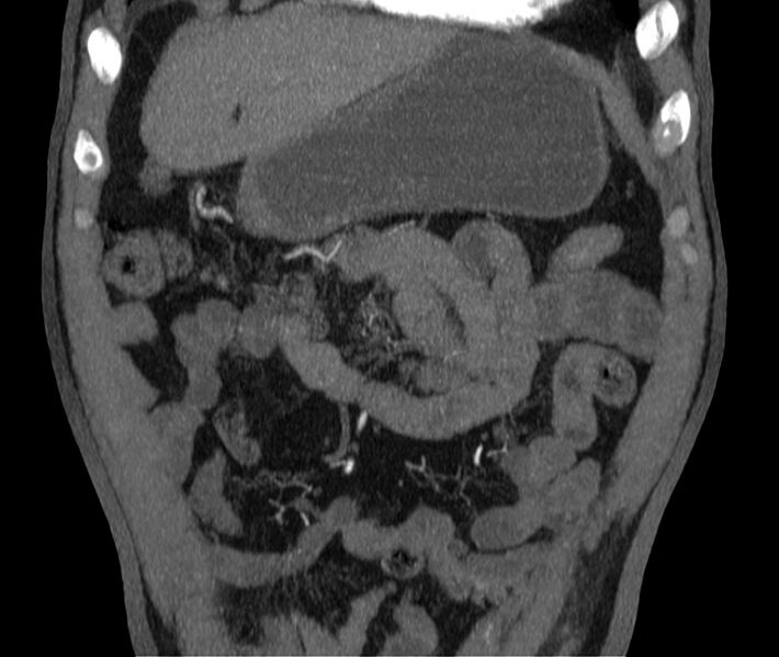 File:Abdominal aortic aneurysm (Radiopaedia 22421-22458 C 3).jpg