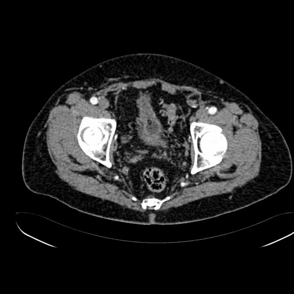 File:Abdominal aortic aneurysm (Radiopaedia 75131-86203 Axial C+ arterial phase 43).jpg